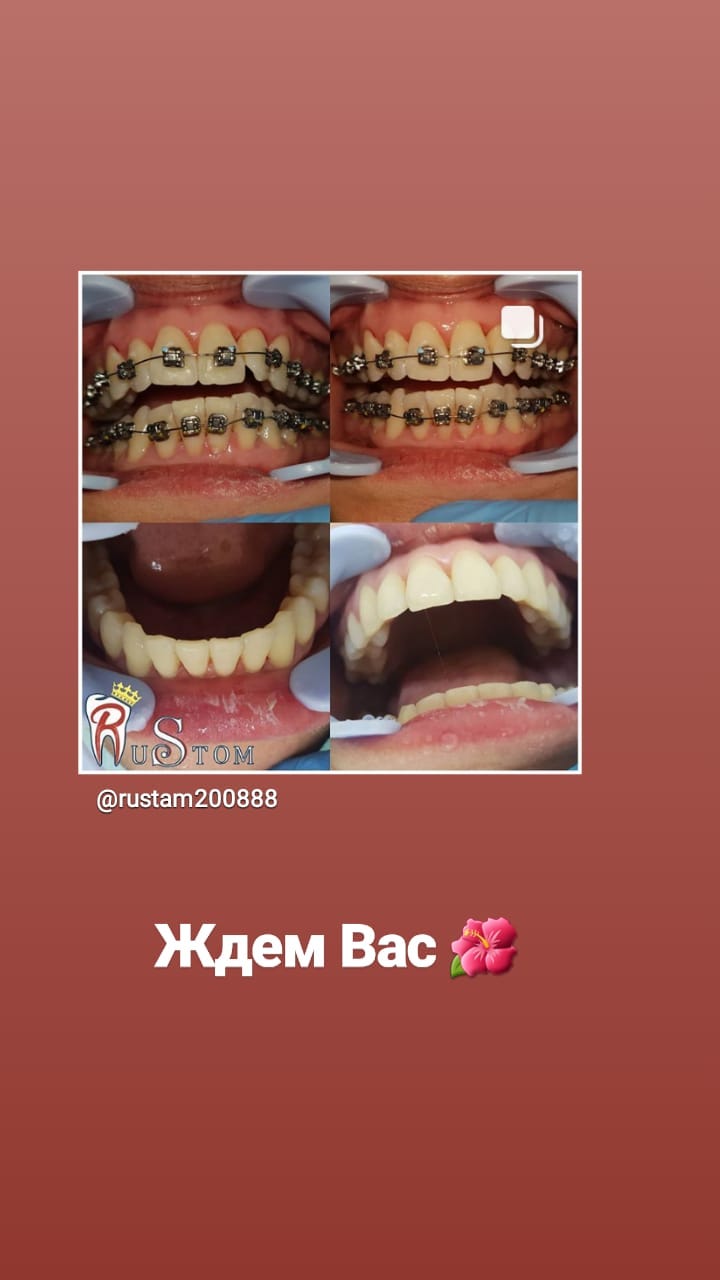 До/После — результат лечения