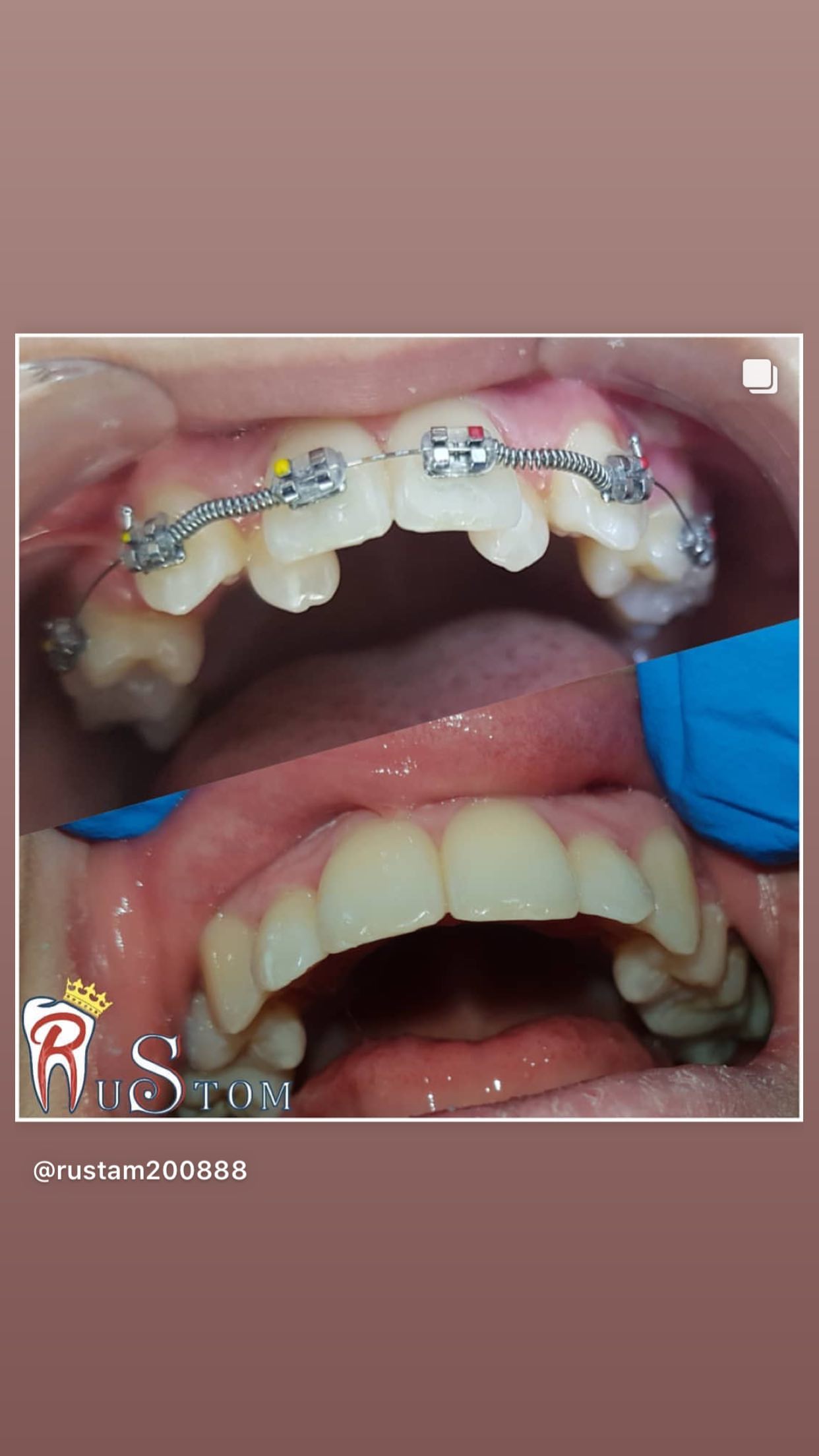 До/После — результат лечения