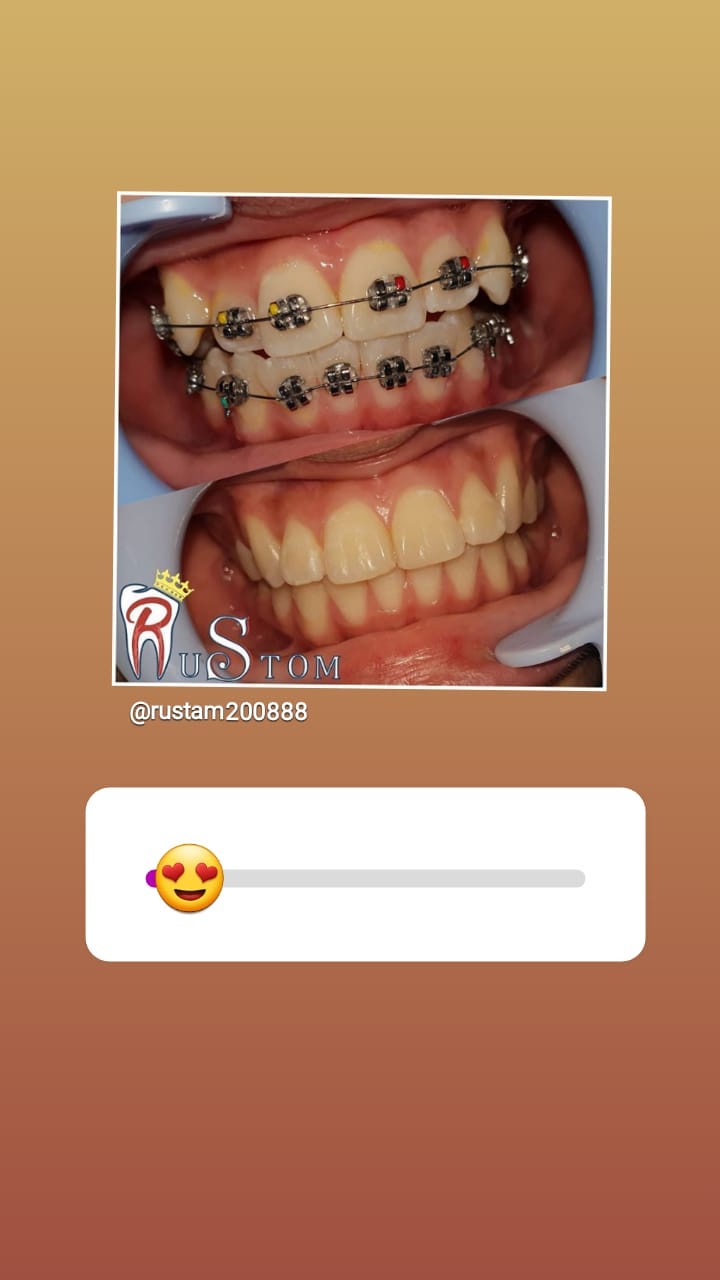 До/После — реставрация