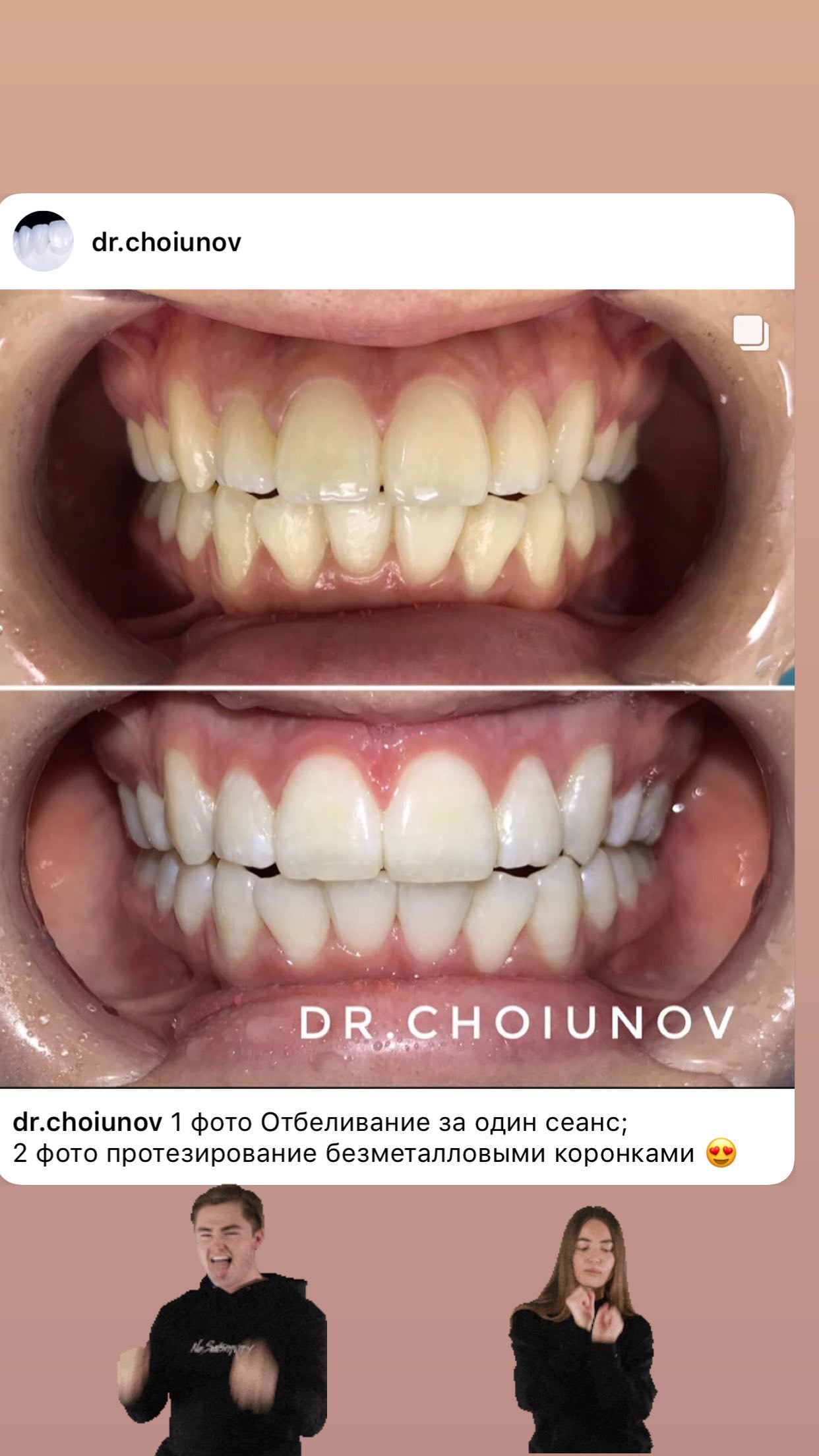 Отбеливание зубов