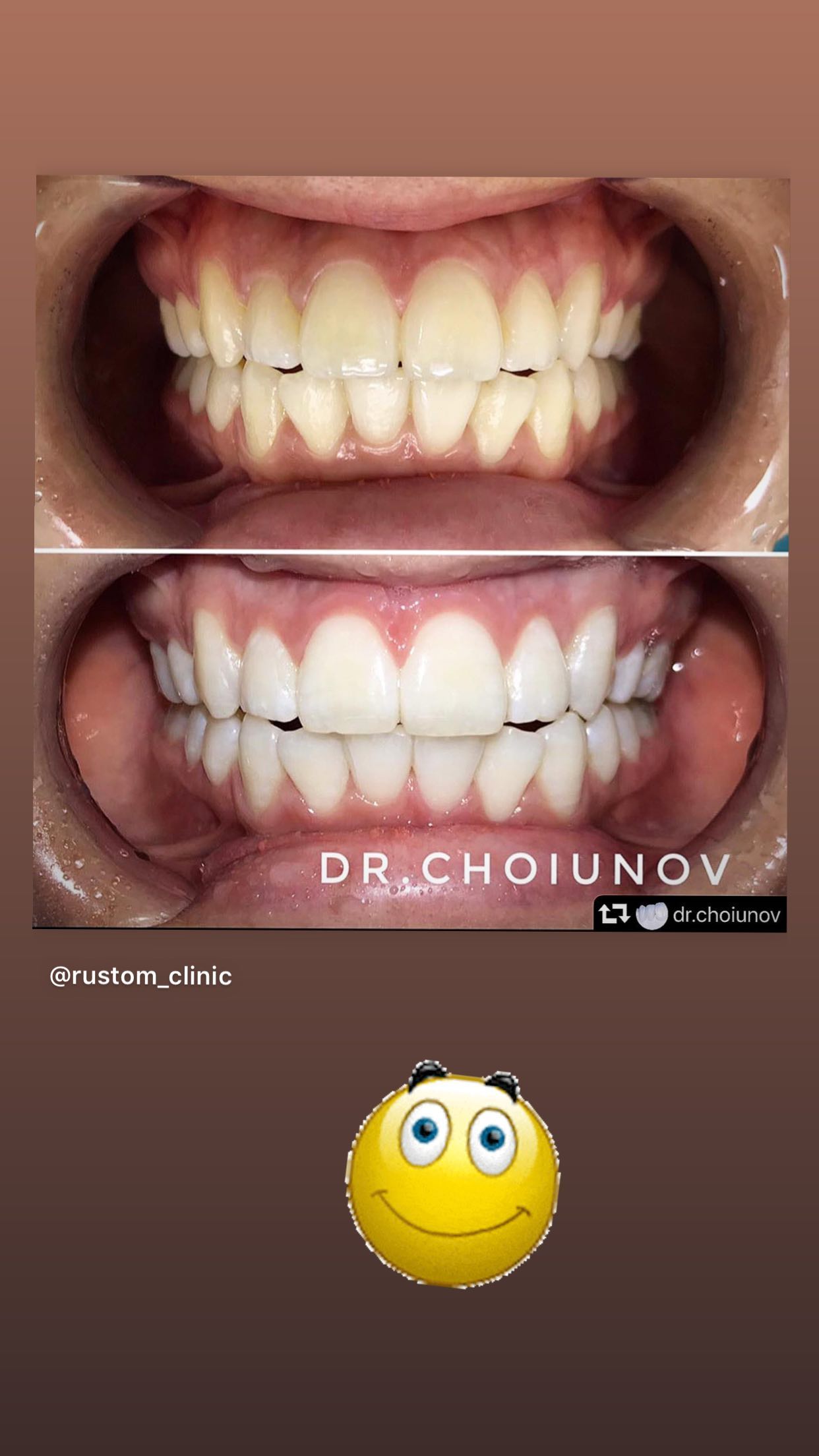 Протезирование безметалловыми коронками