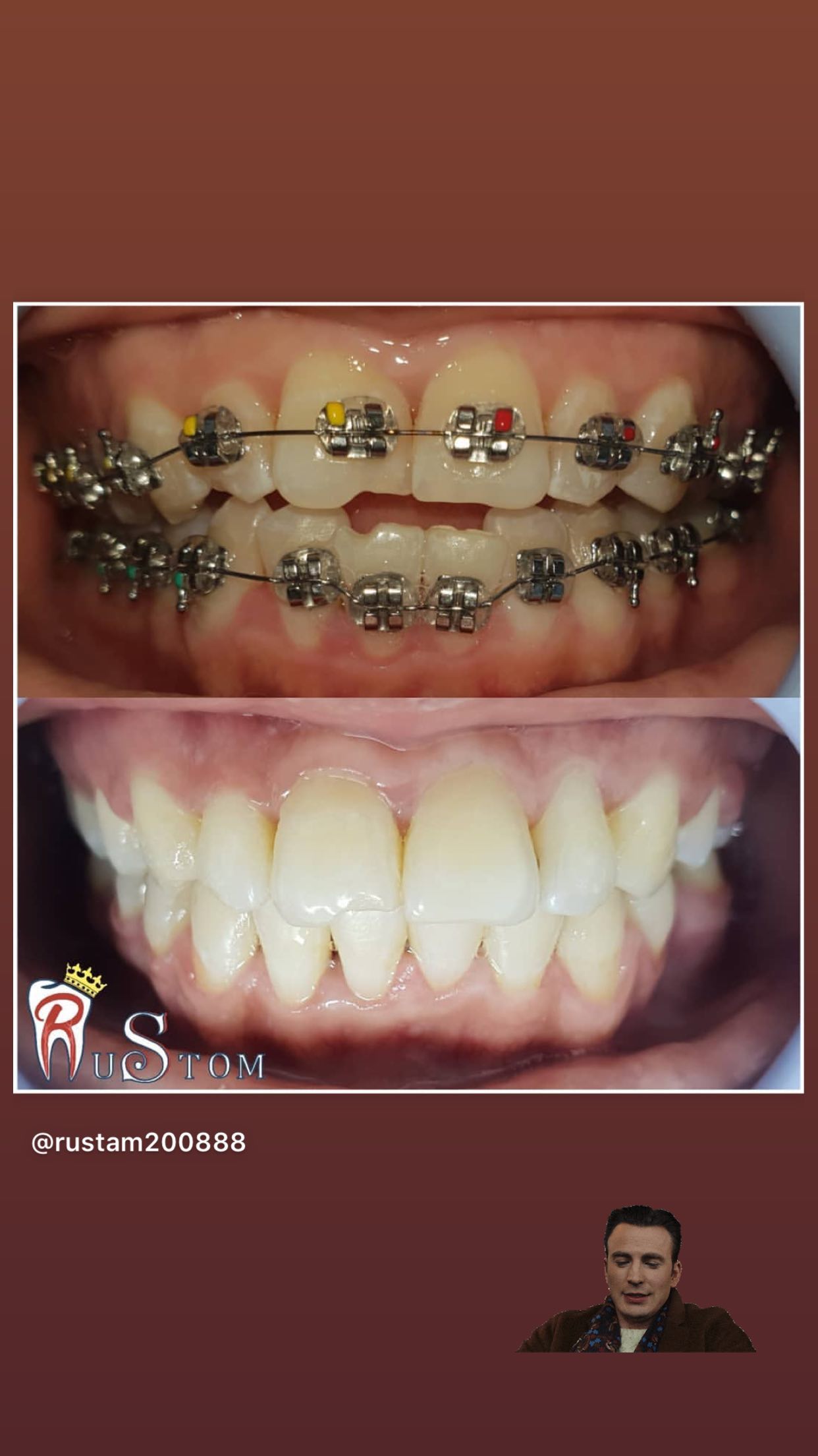 До/После — отбеливание