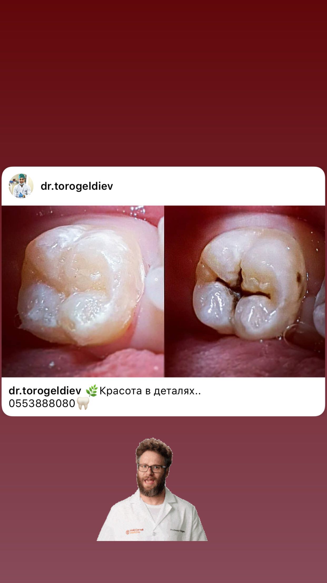 До/После — коронки