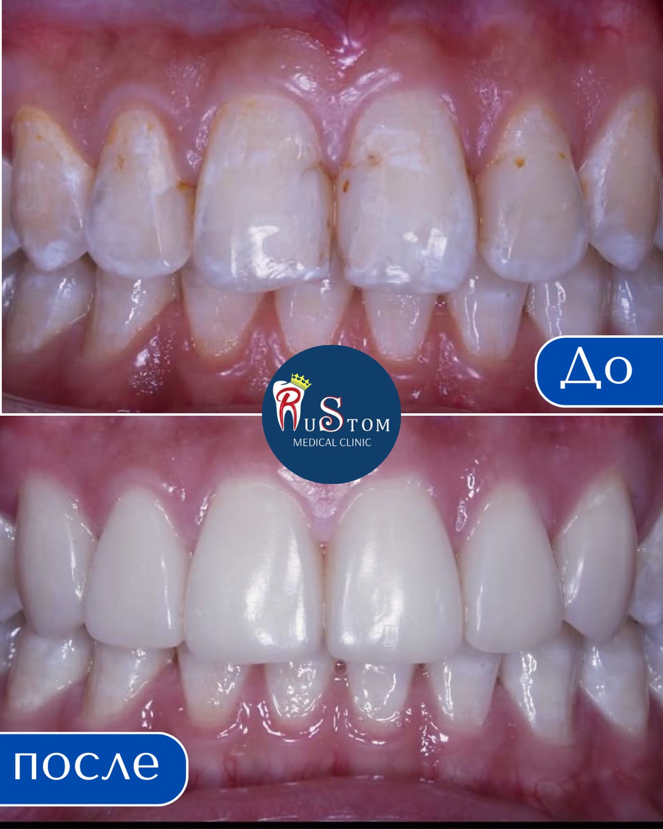 Композитная реставрация