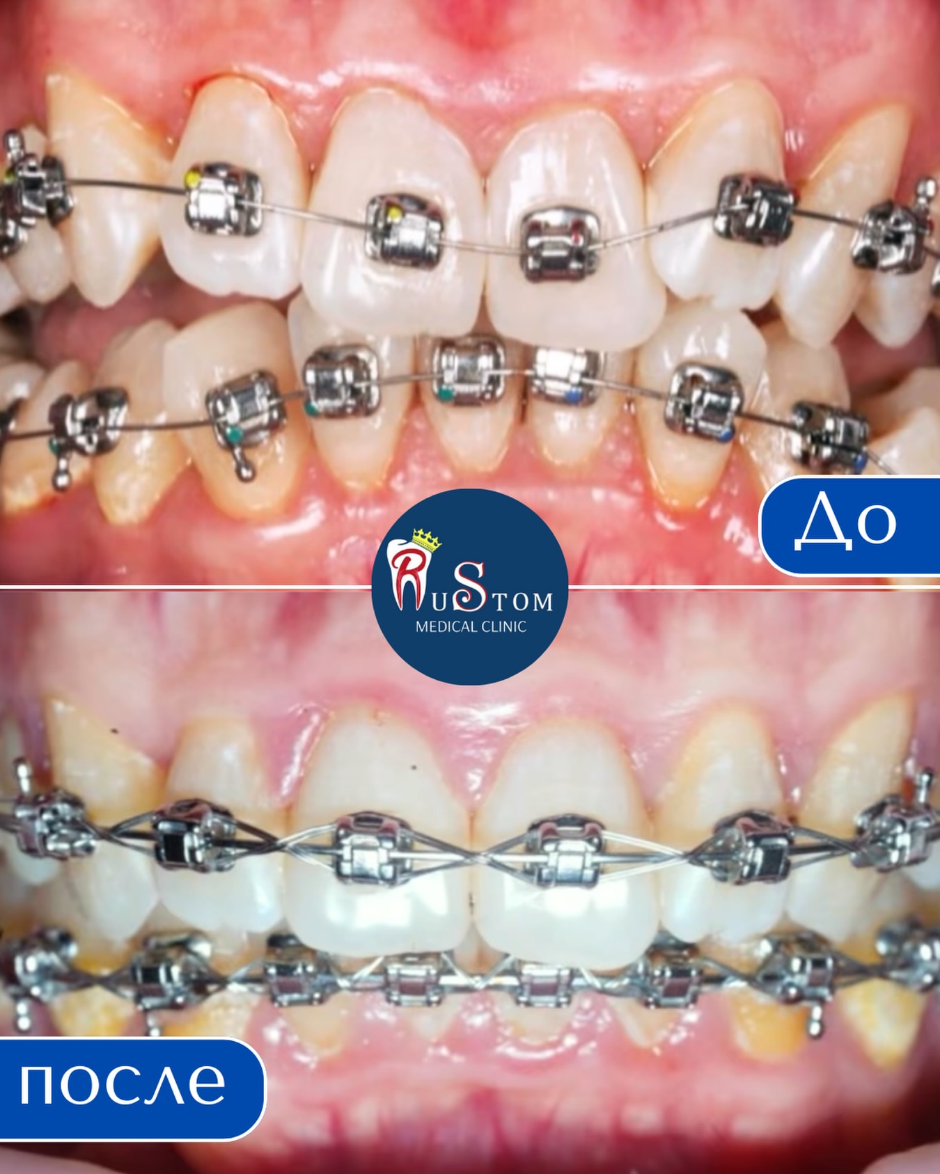 Ортодонтическое лечение