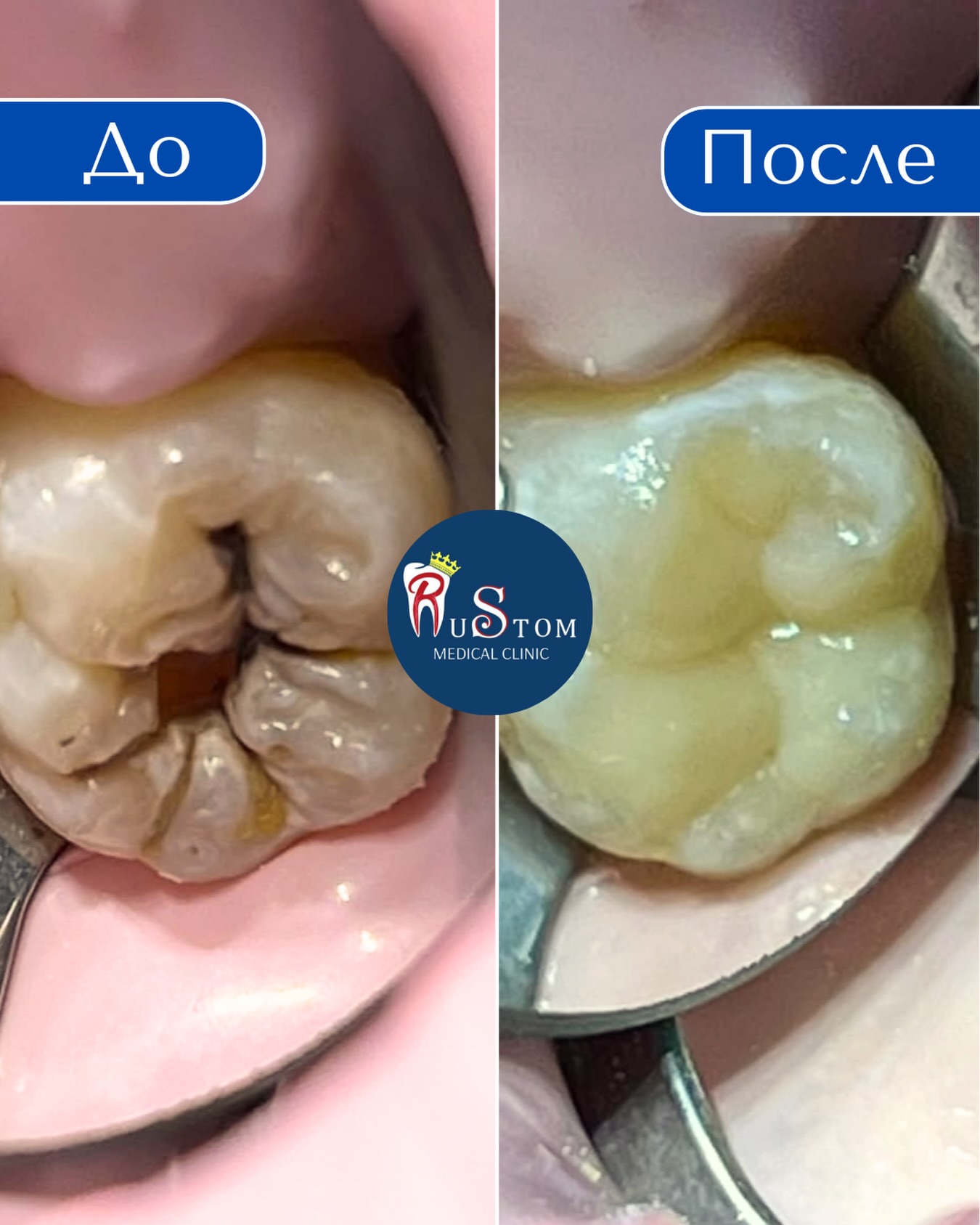 Реставрация зубов — результат