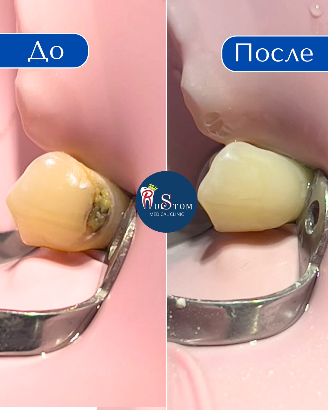 Композитная реставрация зубов