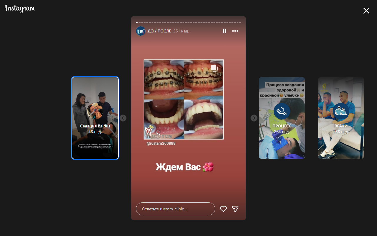 До/После: брекеты