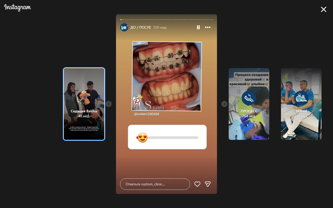 До/после: коррекция прикуса