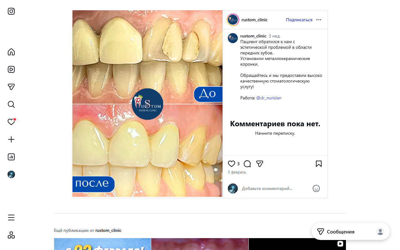 До/после: металлокерамические коронки