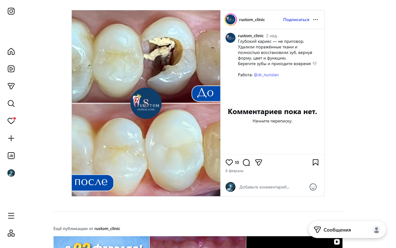 До/после: лечение кариеса