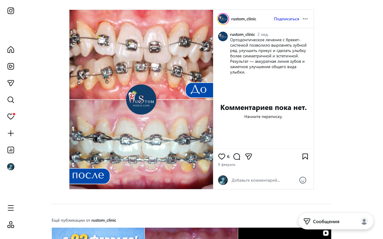 До/после: брекеты